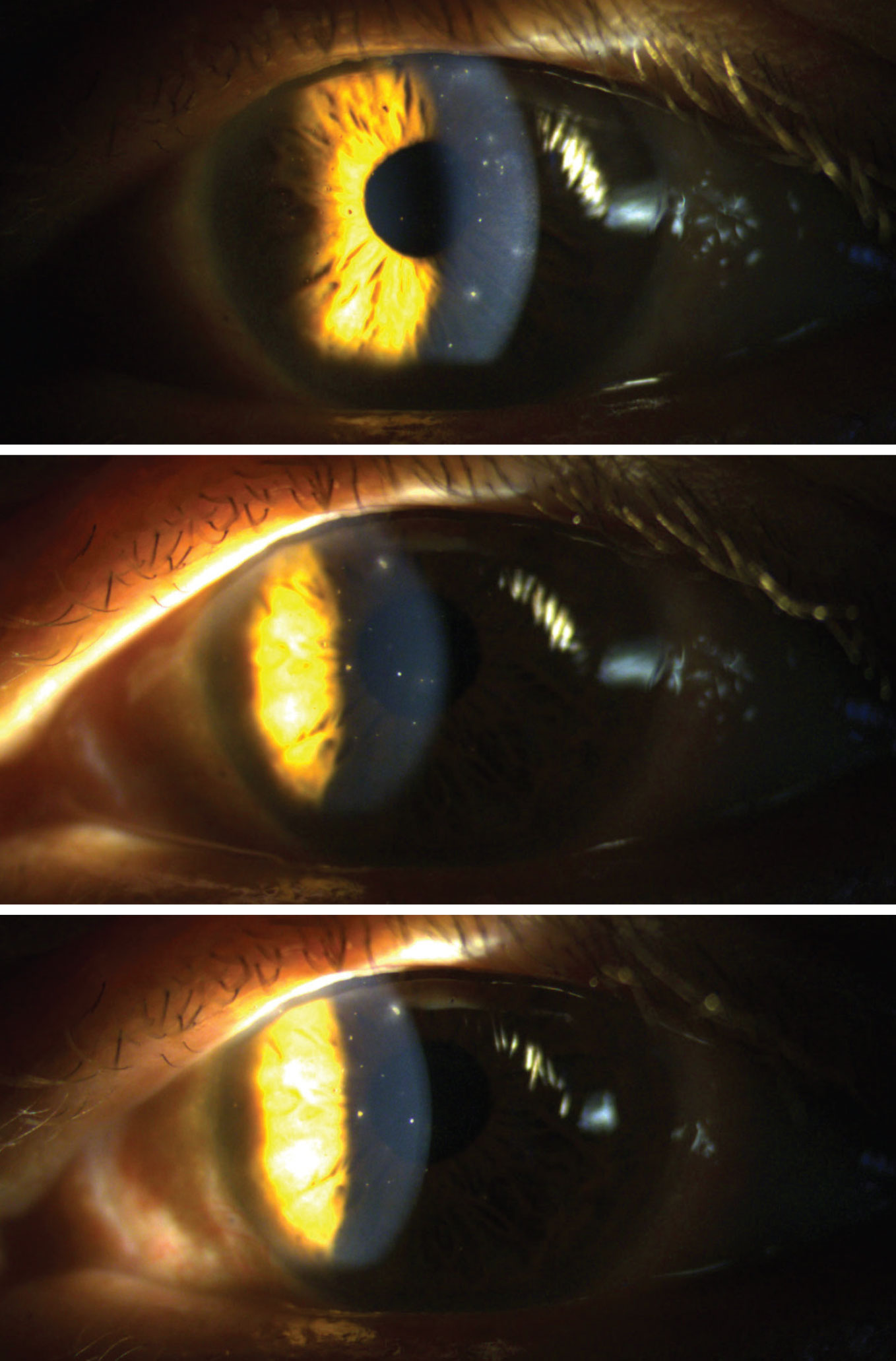 Embedded corneal foreign bodies of differing material scattered throughout the left cornea.