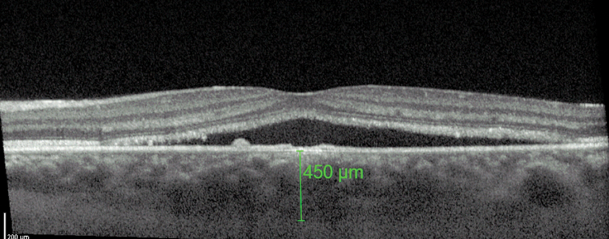 A thicker-than-average choroid is characteristic of central serous chorioretinopathy.