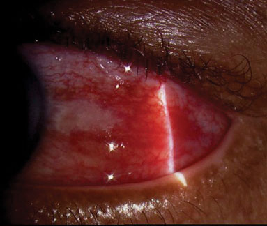 Diffuse anterior scleritis in a 58-year-old male with a subsequent negative systemic workup.