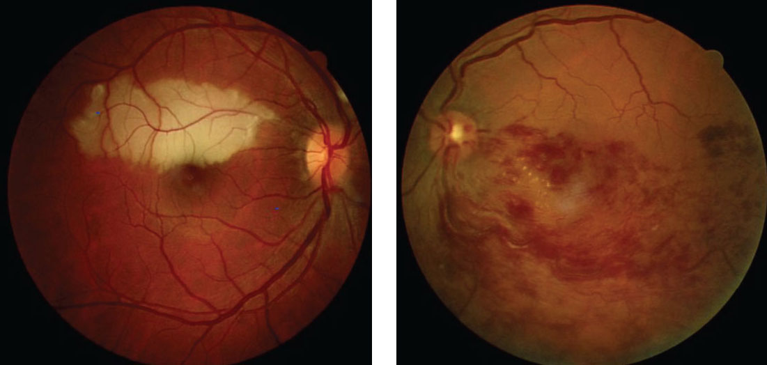 Tobacco use can contribute to problems in the eye's vasculature system, including branch retinal artery occlusion. Image courtesy of Nicholas Karbach, OD, Natalia Kobrenko, OD, Marc Myers, OD and Andrew S. Gurwood, OD. 