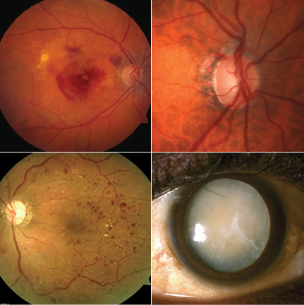 Of 30 million Medicare beneficiaries in this study, 41% had at least one claim for either  AMD, glaucoma, cataract or diabetic retinopathy.