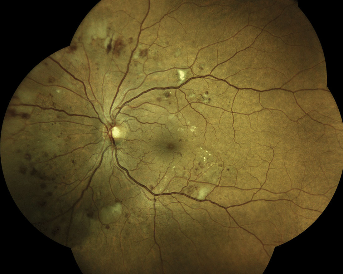 Older age and worse DR severity were the top two risk factors for vision loss identified in this study among patients with diabetes. Photo: Steven Ferrucci, OD. 