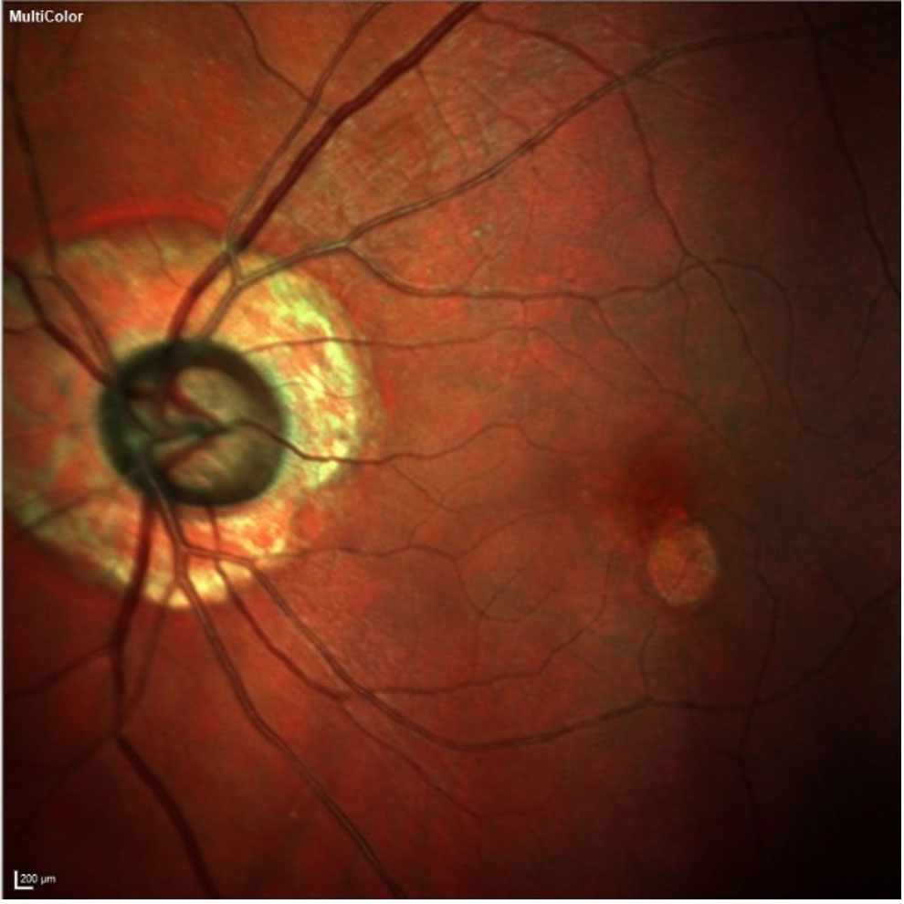 The patient’s left eye demonstrates advanced neuroretinal rim loss, peripapillary atrophy and macular changes. From an OCT perspective, given the peripapillary atrophy and early macular disease, the neuroretinal rim and Bruch’s membrane opening are the structures where we should look to observe more reliable glaucomatous changes.