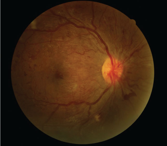 Despite 20/20 best-corrected vision, this type 1 diabetes patient who was seven months pregnant presented with proliferative DR.