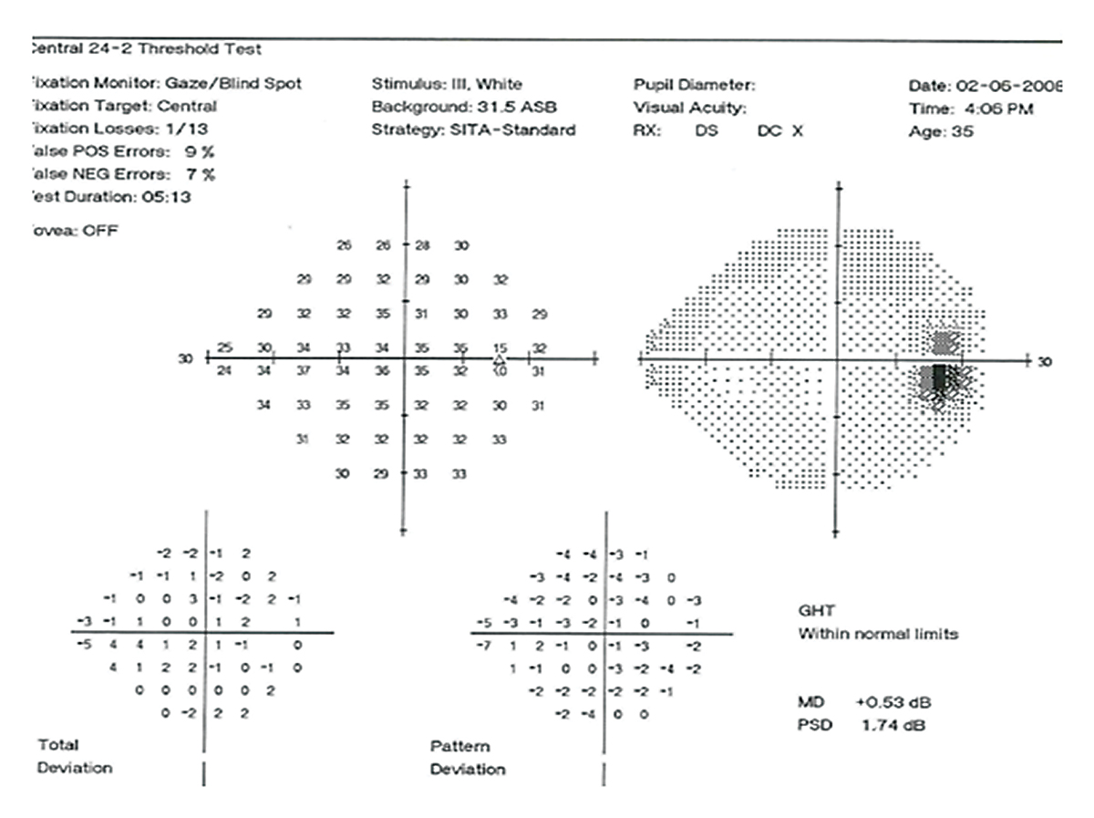 Fig. 1. Patient’s results on 24-2 SAP VF appears “normal” however there is masking of an actual early glaucomatous defect due to the patient’s high “false positive” responses (9%).  