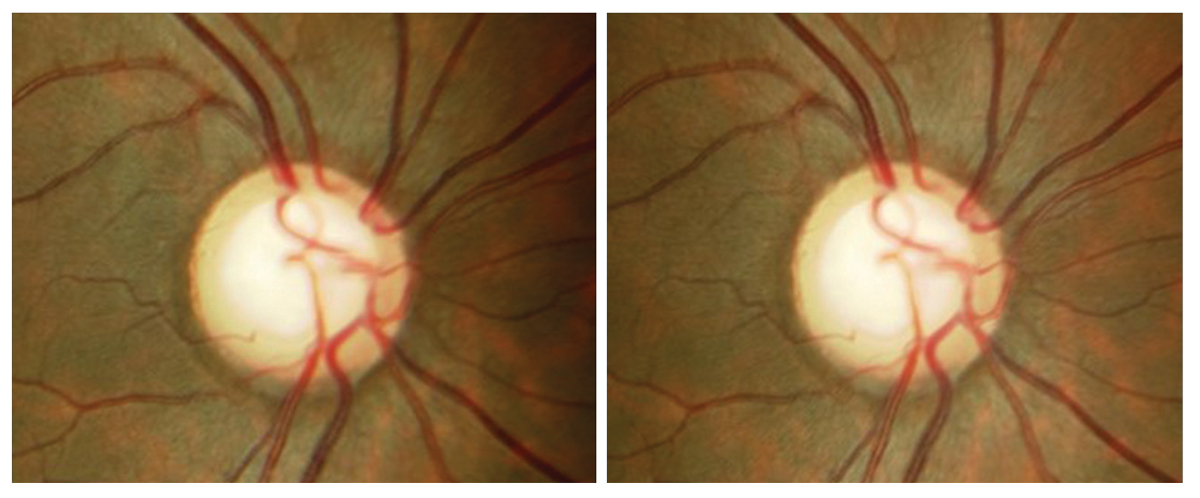 Fig. 3. Patient’s right eye stereoscopic optic nerve images. Notable is the inferior temporal sloping and thinning of the neuroretinal rim tissue that would be difficult to detect without stereoscopic viewing.