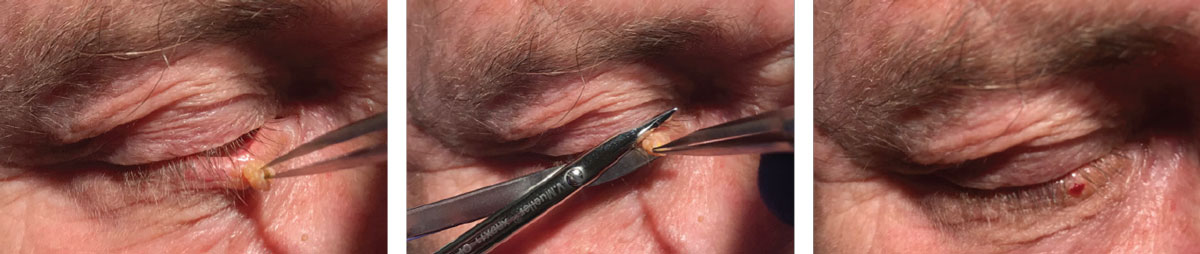 Lesion removal is one procedure being added to practice scope in a growing number of states that gives patients quicker access to care with the ability to be treated in-office. Above: excision of a squamous papilloma in an optometric office.