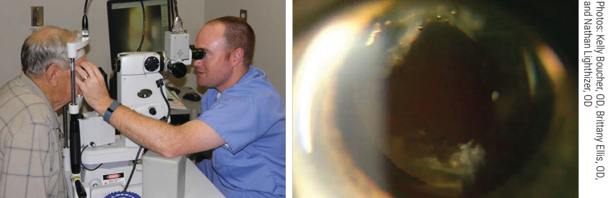Today, capsulotomies can be performed in optometry offices in seven states. Oklahoma was the first state to authorize ODs to do so. At left, Oklahoma’s Nathan Lighthizer, OD, prepares to treat a patient. At right, we see the resulting central clearance postoperatively.
