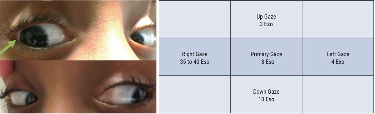 Fig. 3. This patient from this efferent assessment presented with diplopia and was diagnosed with a CN VI palsy. Careful ductions demonstrated a subtle right abduction deficit. Cover testing demonstrated an increasing eso-deviation in right gaze, consistent with the patient’s right CN IV palsy. 