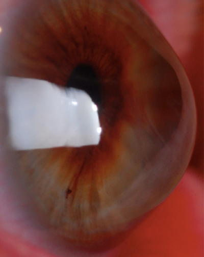 The BAPD proved to be more effective than alternatives in detecting keratoconus progression in this study. Photo: Edward Boshnick, OD.