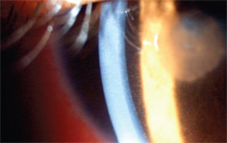 In this study, 84.4% of patients with iritis that developed post-cataract surgery had steroid dependency. Photo: Paul M. Karpecki, OD. 