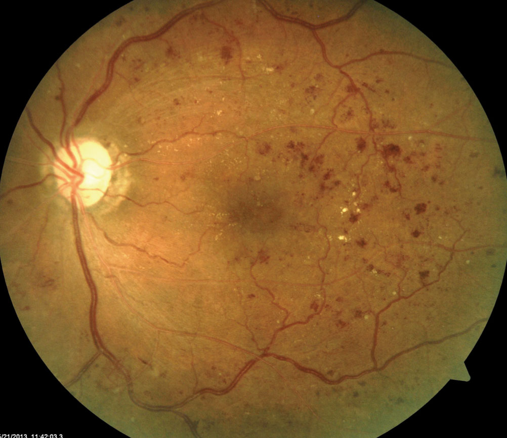 When including diabetes management, multiple imaging modalities—to catch signs of diabetic retinopathy, for example, as seen here—are important to have in your practice.