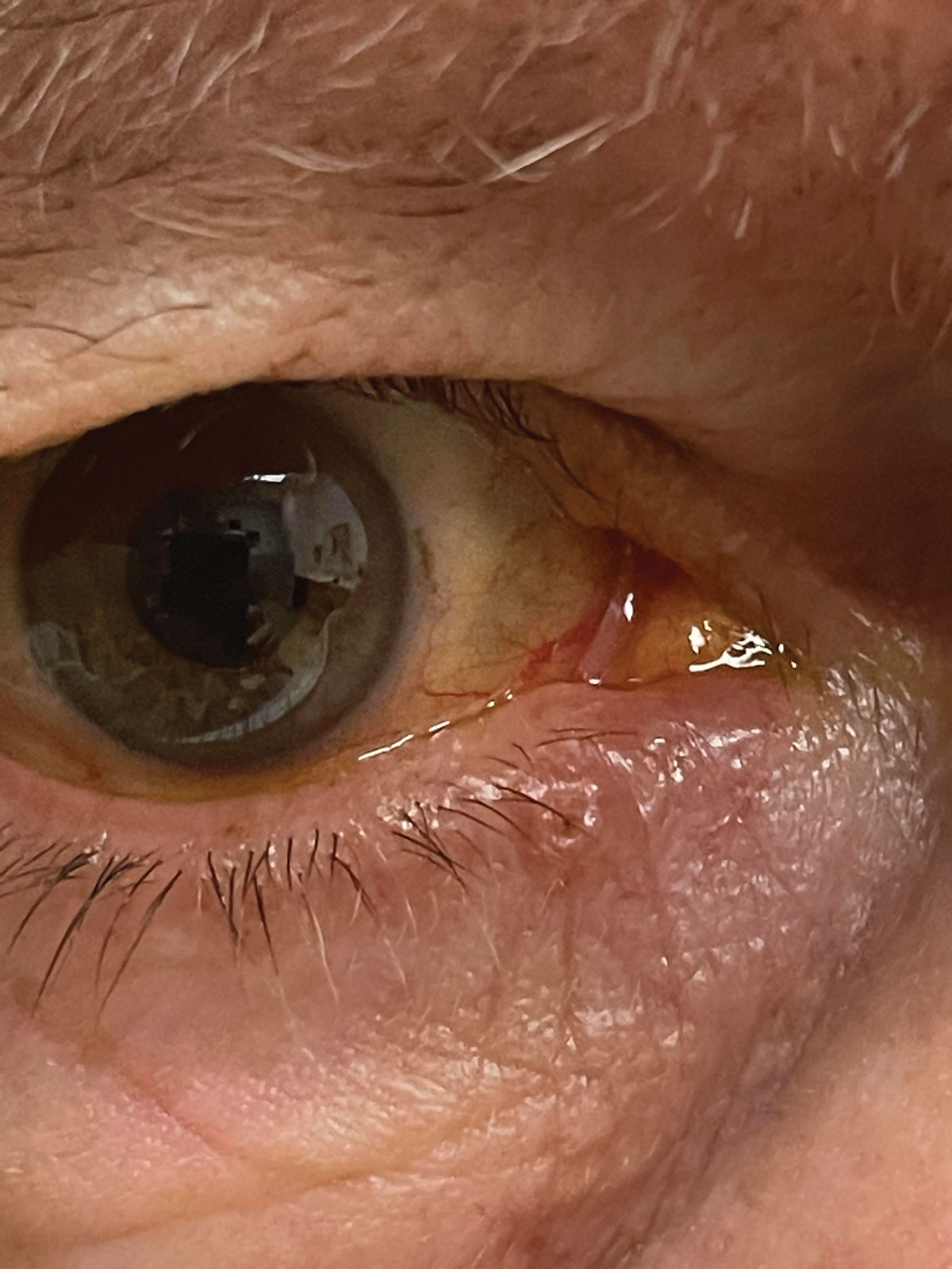 Suspicious non-healing, ulcerated skin lesion along the lower lid margin that the patient reported as becoming slightly larger over several months. Referral was made to oculoplastic surgeon to confirm diagnosis and necessary treatment of malignancy vs. benign lesion.