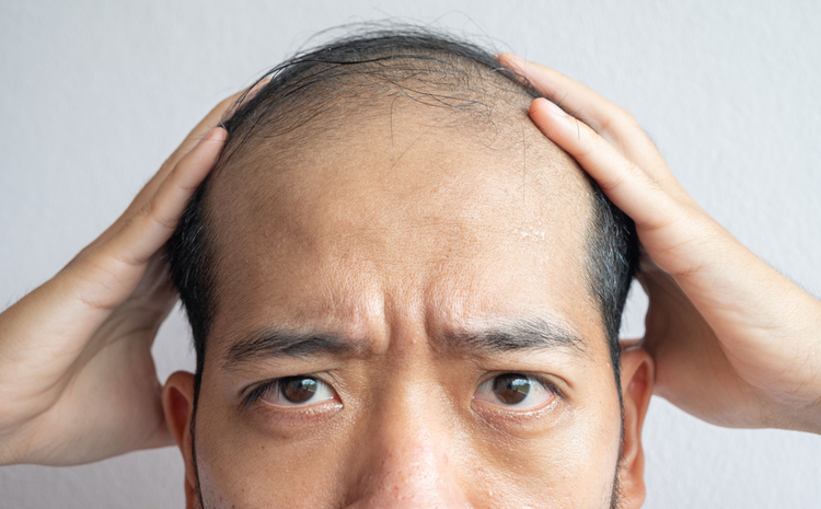 Hair Growth Drug May Increase Risk of Retinal Artery Occlusion
