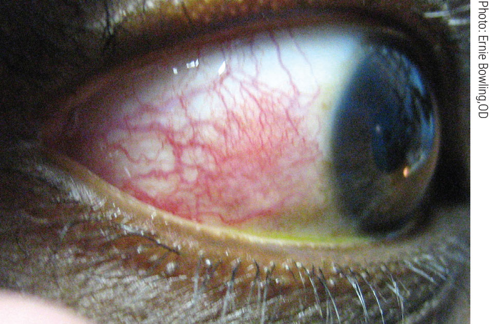 Episcleritis can present with complaints of discomfort or irritation (rather than true eye pain), redness and edema to the affected area over the sclera.
