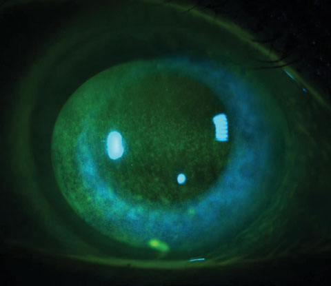 Although it may be limited, glaucoma can have an effect on ocular dryness. Photo: Jacob R. Lang, OD