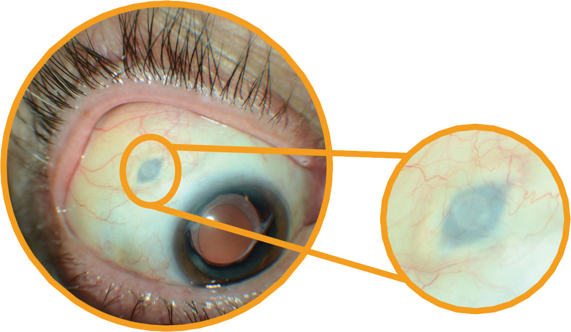 The tip of the implant remains visible beneath the conjunctiva.