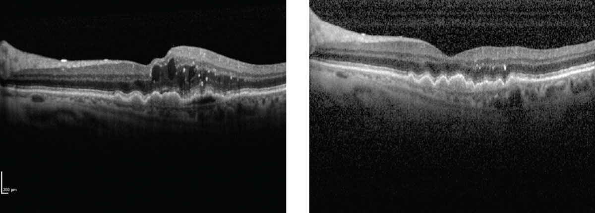 This image shows a wet AMD patient before and after treatment administered by the device. 