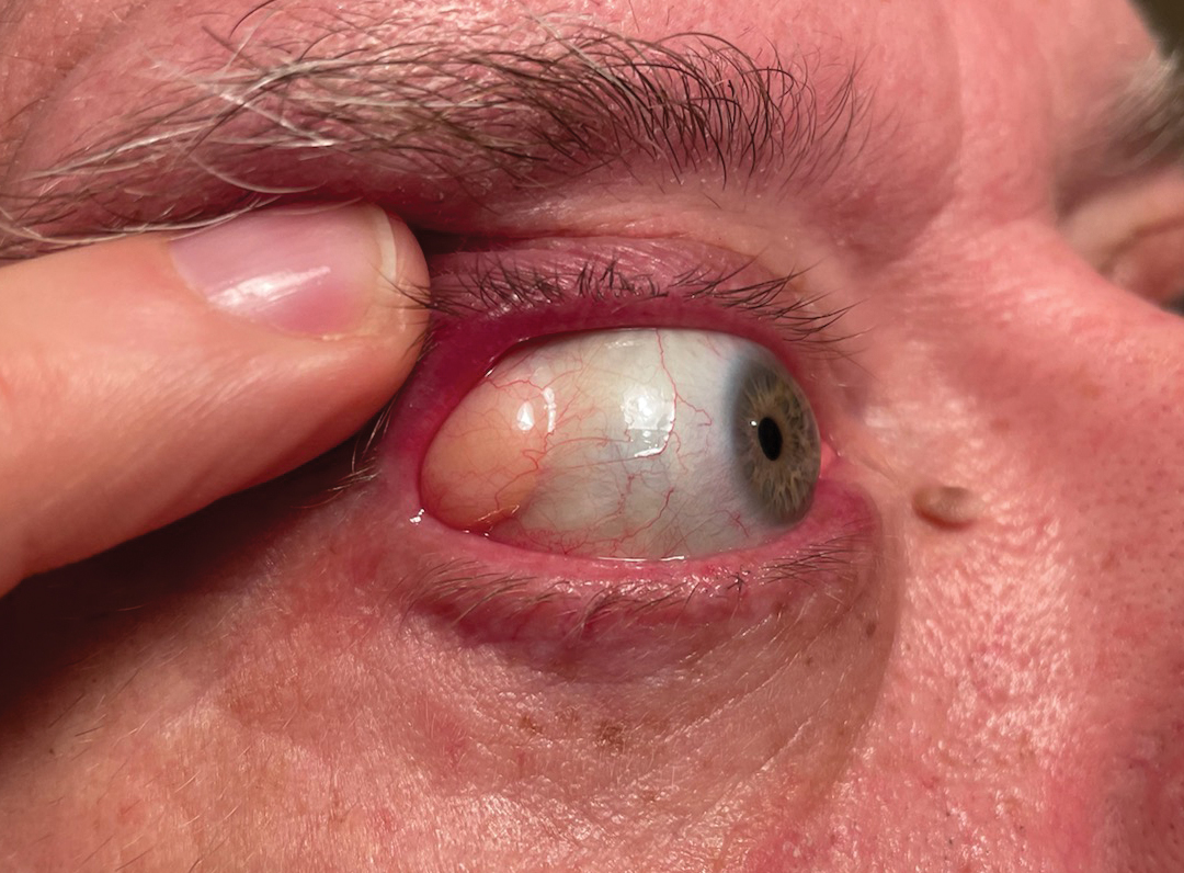 Subconjunctival orbital fat may be prolapsed secondary to aging, trauma or surgery.