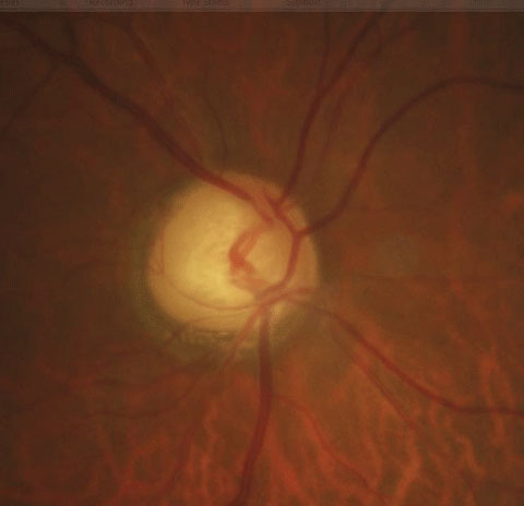 Though stereoscopic evaluation and OCT are standard techniques when assessing glaucoma, ophthalmic ultrasound may also yield important clues, study finds. Photo: Justin Cole, OD, and Jarett Mazzarella, OD.
