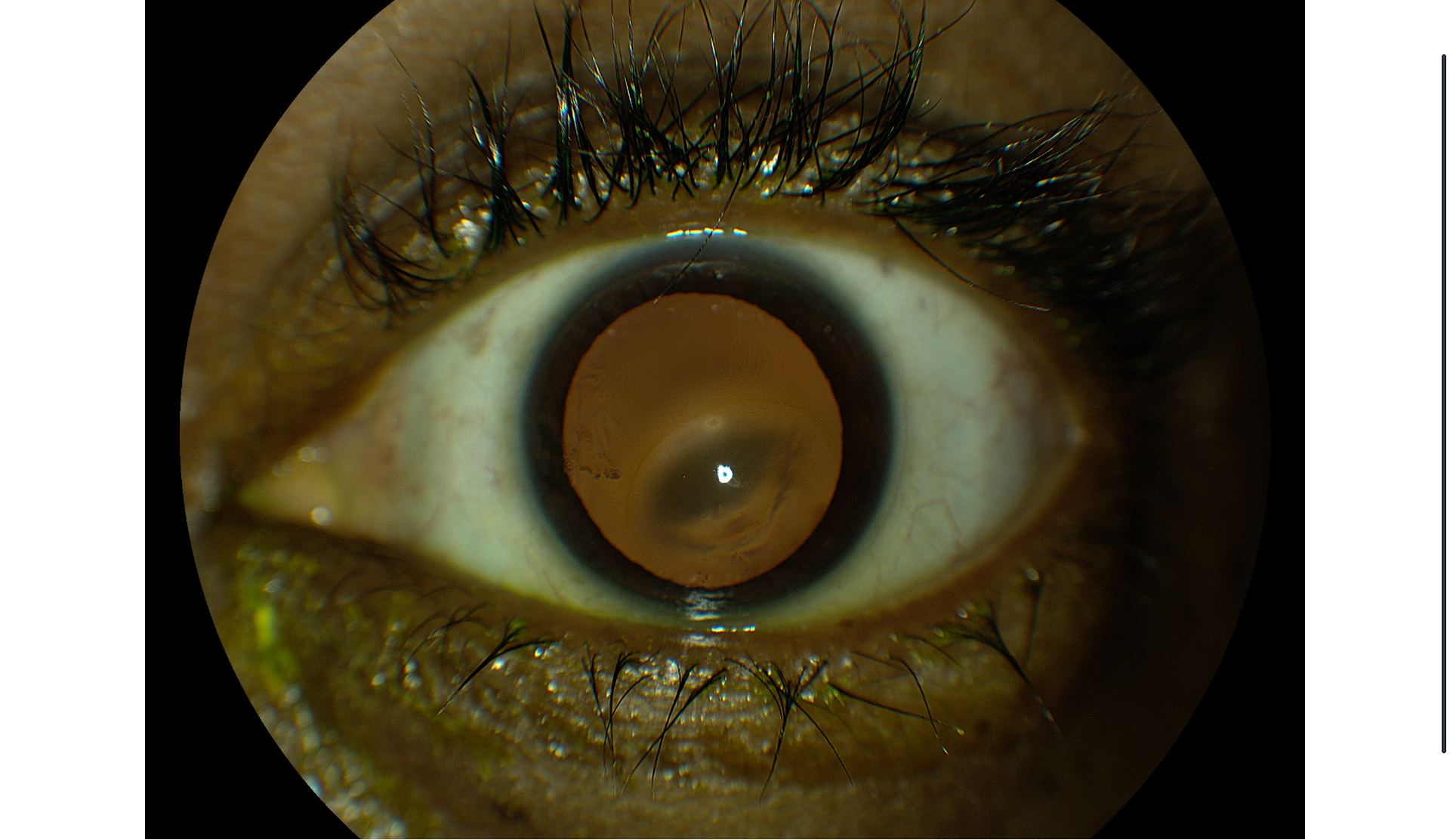 Keratoconus progresses more rapidly in children than in adults. 