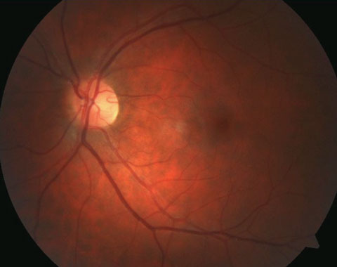 The 20% of eyes with a cilioretinal artery may hold an advantage of lower AMD advancement risk. Photo: Bisant A. Labib, OD, Andrew S. Gurwood, OD, and Andrew L. Meagher, OD.