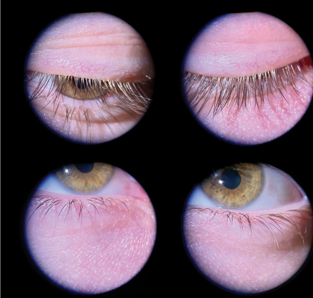 Fig. 1. Mild anterior blepharitis in a younger male patient with collarettes at the base of the lashes and mild flaking throughout. Although mild, it is important to treat early to prevent disease progression. This patient undergoes quarterly in-office treatments.