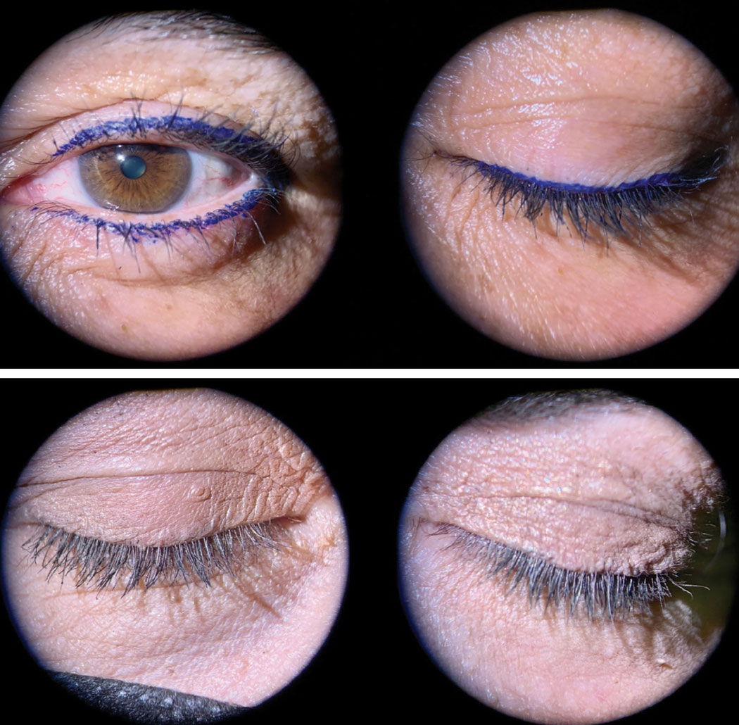 Fig. 4. Top: Excess makeup at the base of the lashes with eyeliners can increase blepharitis. Bottom: Excess foundation and face powder are often used by some patients to cover lid redness or discoloration. This, with mascara, has left the lashes and lid margins coated with makeup.
