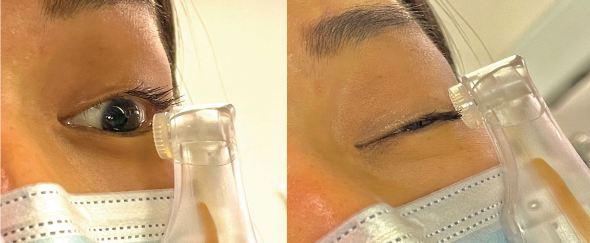 Fig. 7. Patient using NuLids electronic lid cleaning system on lower and upper eyelids for at-home cleaning.