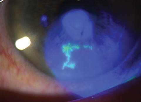 HSV may cause ocular disease in more patients than previously observed. Photo: Lisa Martén, MD.