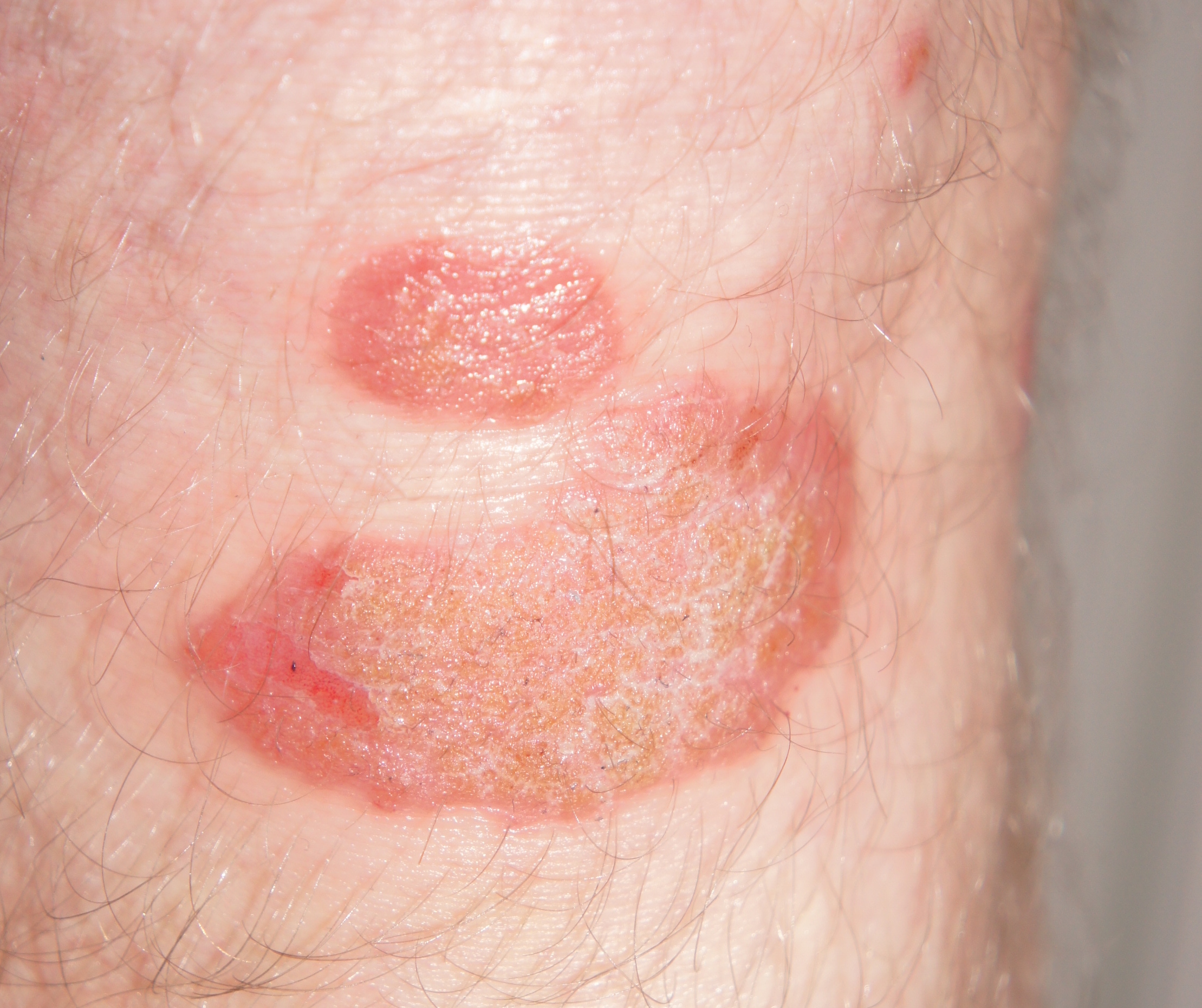 This study found a link between psoriasis and MGD. Photo: www.paul-hat-schuppenflechte.de, Wikicommons.