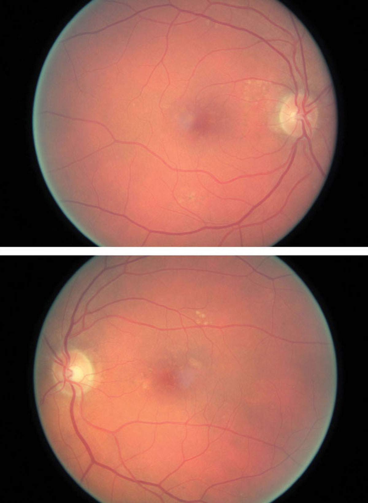 The risk of late AMD is not heightened in patients who undergo cataract surgery. Photo: Amanda Legge, OD. 
