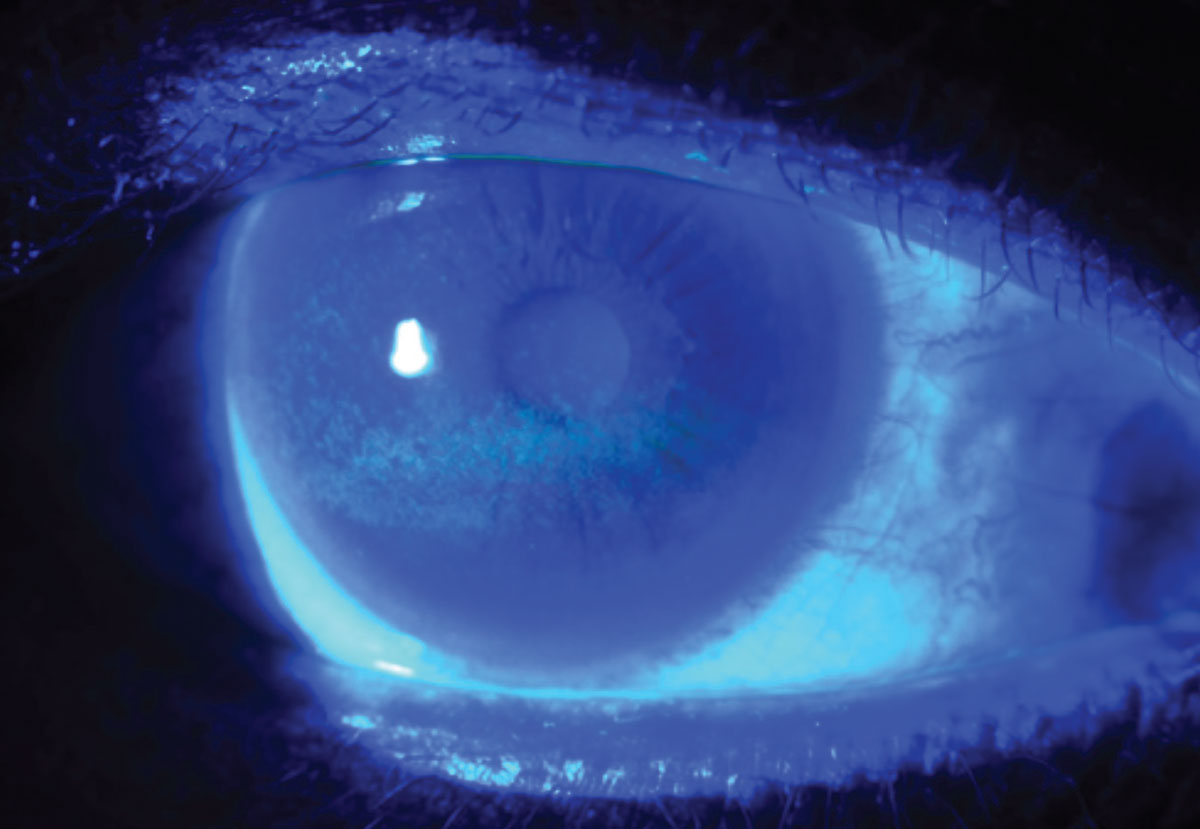 Punctate epithelial erosions in a dry eye patient as revealed by fluorescein dye.