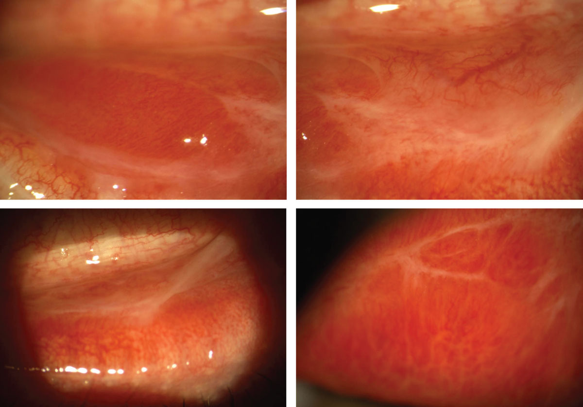 True conjunctival membranes and residual conjunctival scarring in the same 30-year-old Caucasian male in the previous set of photos with severe bilateral bacterial conjunctivitis. The membranes were confirmed when a damp cotton swab was unsuccessful in removal. Once discharge subsided and the ocular surface was considered sterile, the patient was treated with aggressive topical steroids to minimize conjunctival scarring and resolve corneal infiltrates.
