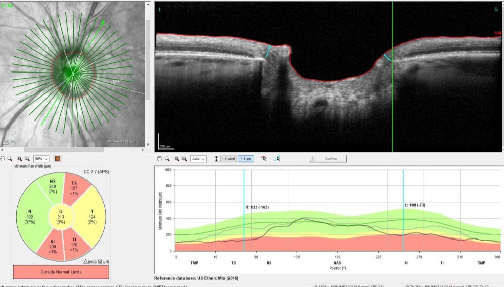 Radial scans of the neuroretinal rim, measuring the BMO-MRW. Note that this is a follow-up scan compared with baseline, and in the superotemporal sector indicated, there is a 163μm decrease in neuroretinal rim width. This is not related to VMA release.