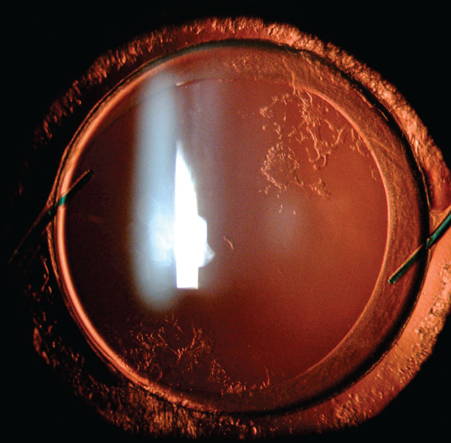 Posterior capsular opacification may present months or years after cataract surgery and require YAG laser capsulotomy.