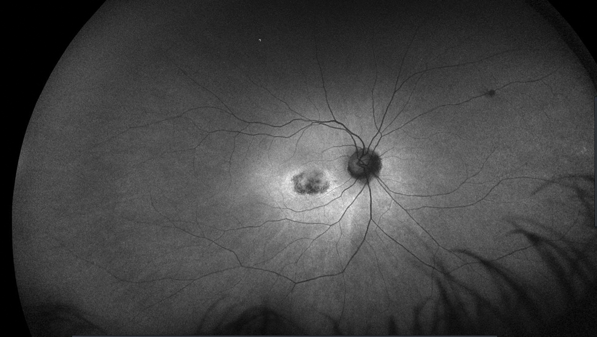 This image, taken five years after discontinuation of HCQ, shows abnormal FAF in the right eye of a patient who had been on the drug for over a decade.