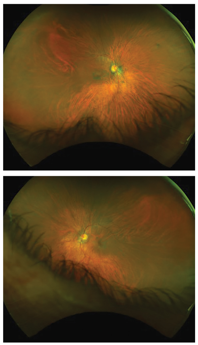Five years after this patient stopped taking Plaquenil, the fundus images highlight some of the damage it left behind (OD, top; OS, bottom). Note the incomplete bullseye maculopathy OD.