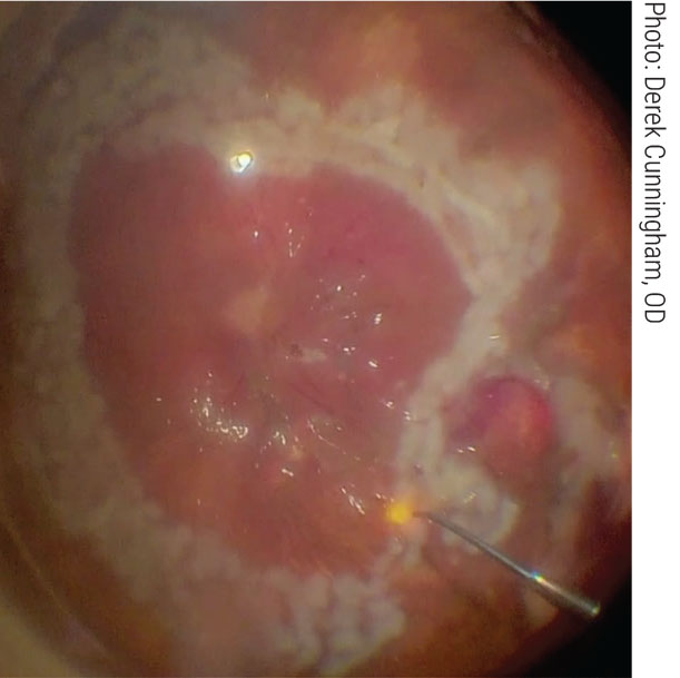 Subretinal scar tissue is removed during a silicone vitrectomy.