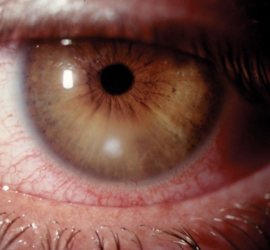 An ongoing study will determine which treatment option for keratitis has the best outcomes. Photo: Joseph W. Sowka, OD. 