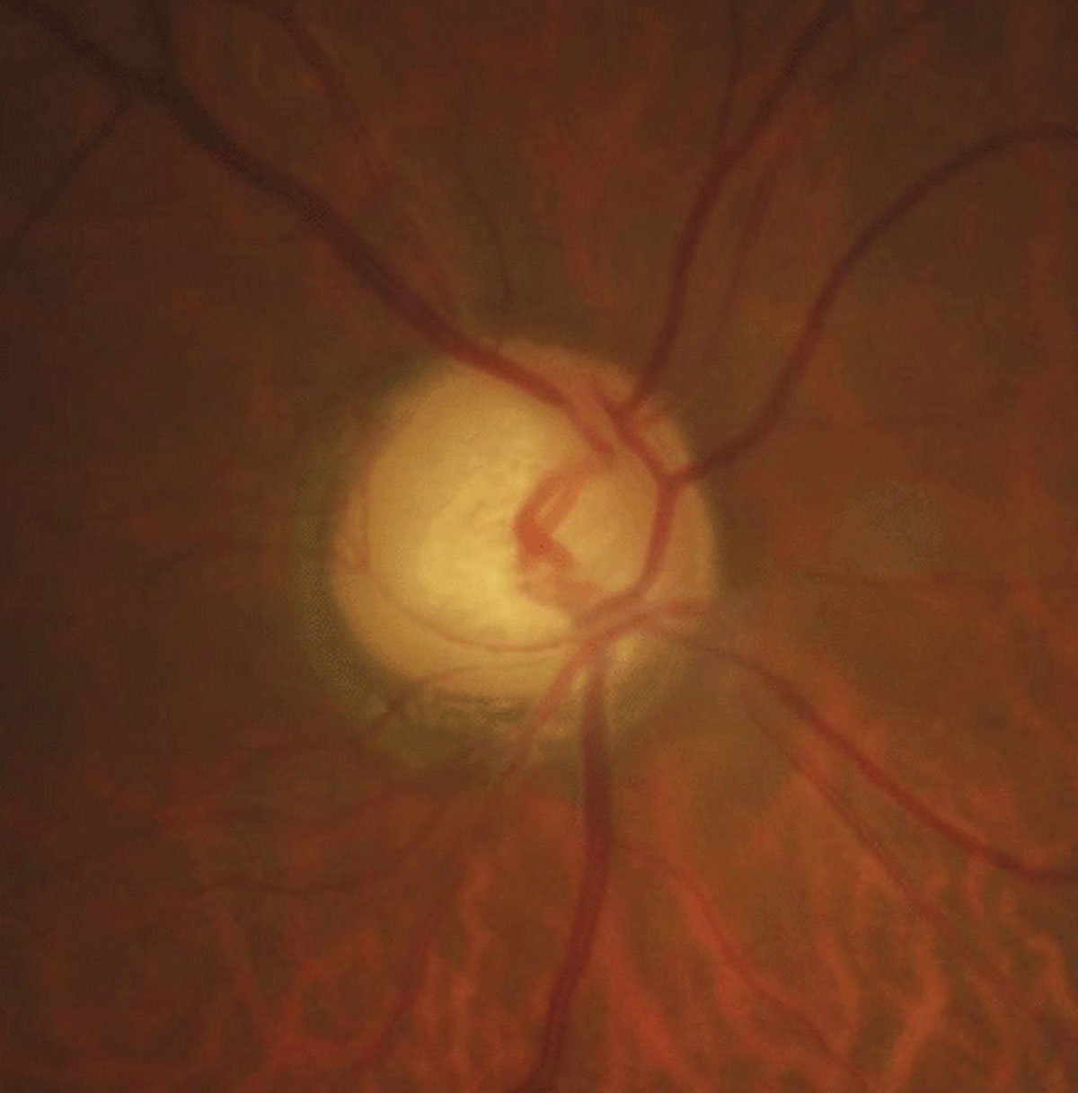 Chromatic pupillometry helps identify abnormal light responses in glaucoma. Photo: Justin Cole, OD, and Jarett Mazzarella, OD.