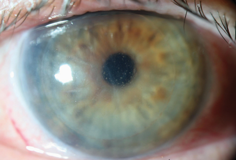 Corneal transplant patients who receive the COVID-19 mRNA vaccination may be more subject to rejection.
