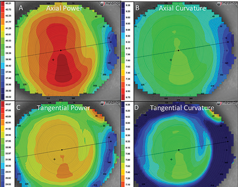 Central corneal thickness, thinnest corneal thickness and corneal volume appeared to correlate with AL in myopic patients in this study. Photo: Maria Walker, OD. 