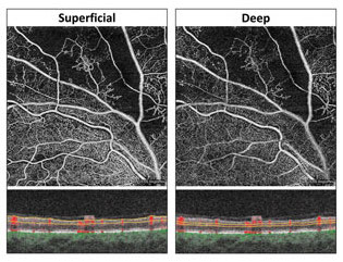 Superficial and deep capillary plexuses help adjust blood flow in response to metabolic changes. Photo: Carolyn Majcher, OD. 