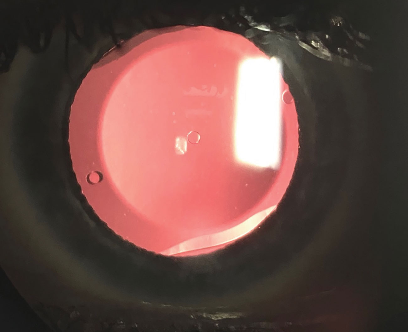 Fig. 3. A slit lamp photo shows the Evo ICL, which has a central port and will allow patients to have the ICL procedure without the need for an iridotomy. This will hopefully be approved soon by the FDA.