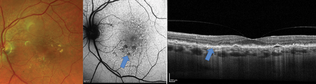 Be careful not to misinterpret subretinal transient hyporeflectivity as subretinal fluid in AMD patients. Photo: Jessica Haynes, OD, James Williamson, OD, and Mohammad Rafieetary, OD. 