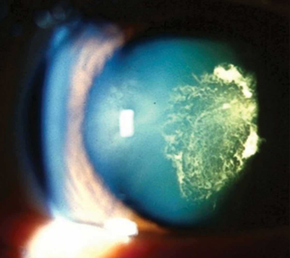 Patient-practitioner collaboration contributes to more successful cataract outcomes. Photo: Julie Tyler, OD.