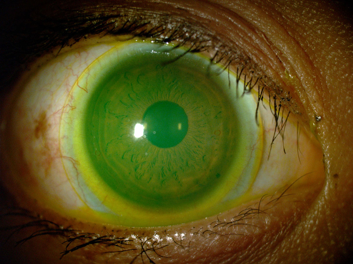 Scleral lens wear wasn't found to affect meibomian gland visibility in most cases.