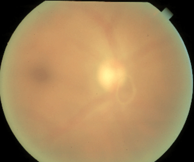 Look out for Weiss Ring when observing scans for progression. 
