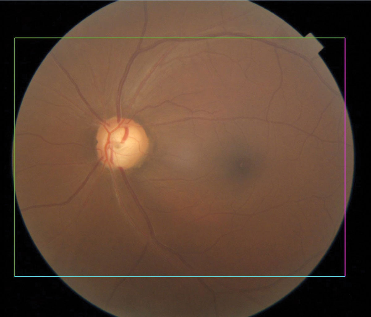 Glaucomatous optic nerve with inferior notching.
